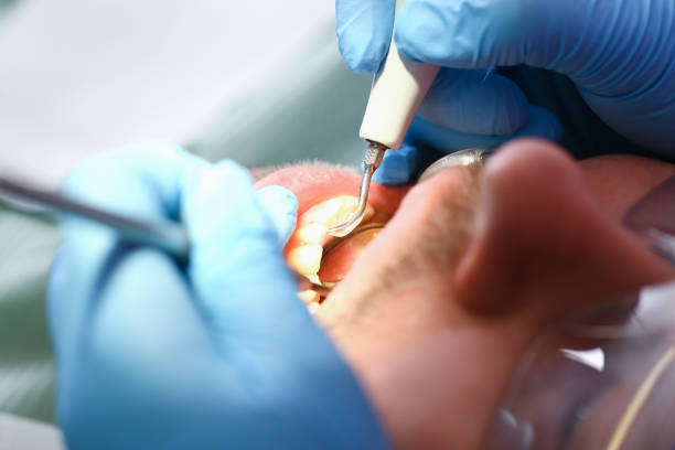 Best Emergency Root Canal Treatment in Old Greenwich, CT