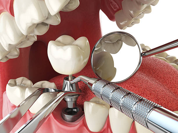 Best Emergency Dental Care for Broken or Chipped Teeth in Old Greenwich, CT
